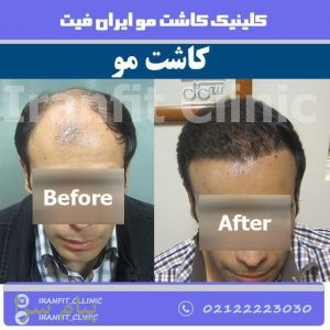 کاشت مو ایران فیت