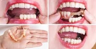 دندان ژله ای