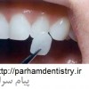 اصلاح بد شکلی دندان در یک جلسه